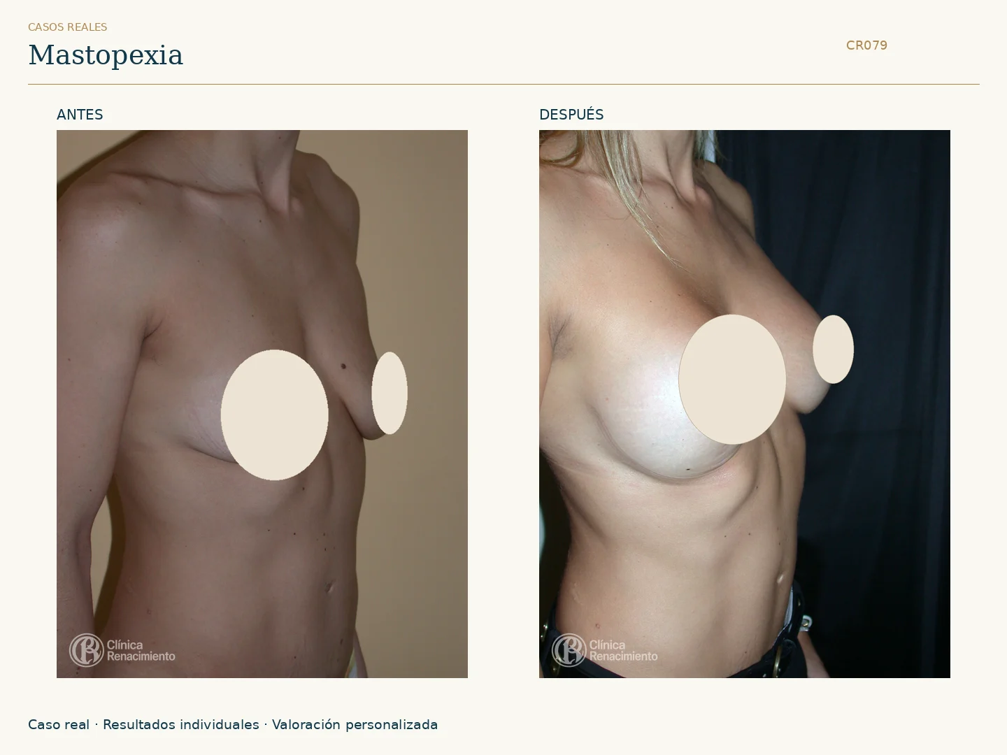 Elevación de senos / Mastopexia: antes y después, vista oblicua derecha. Clínica Renacimiento Marbella.