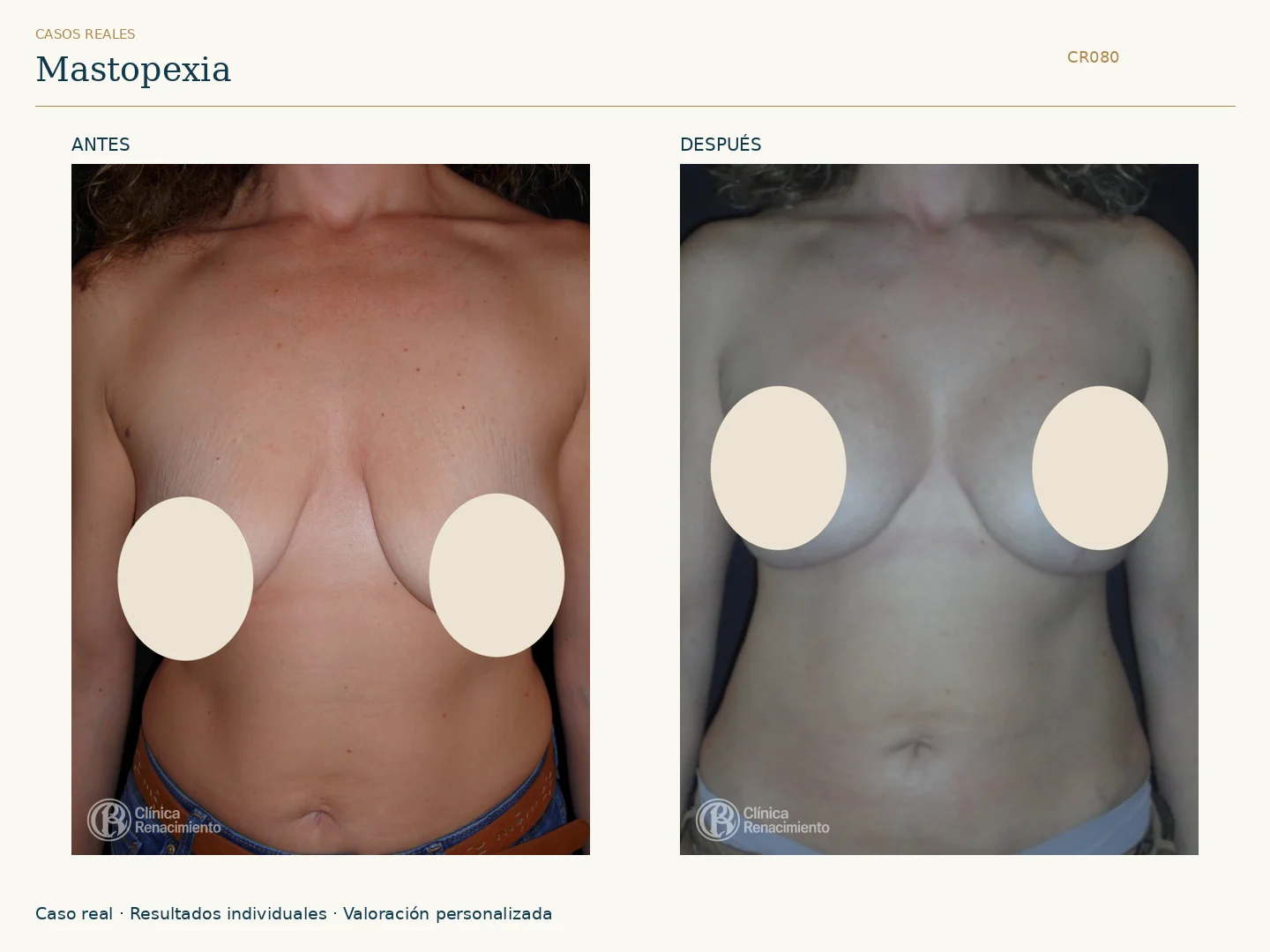 Elevación de senos / Mastopexia: antes y después, vista frontal. Clínica Renacimiento Marbella.
