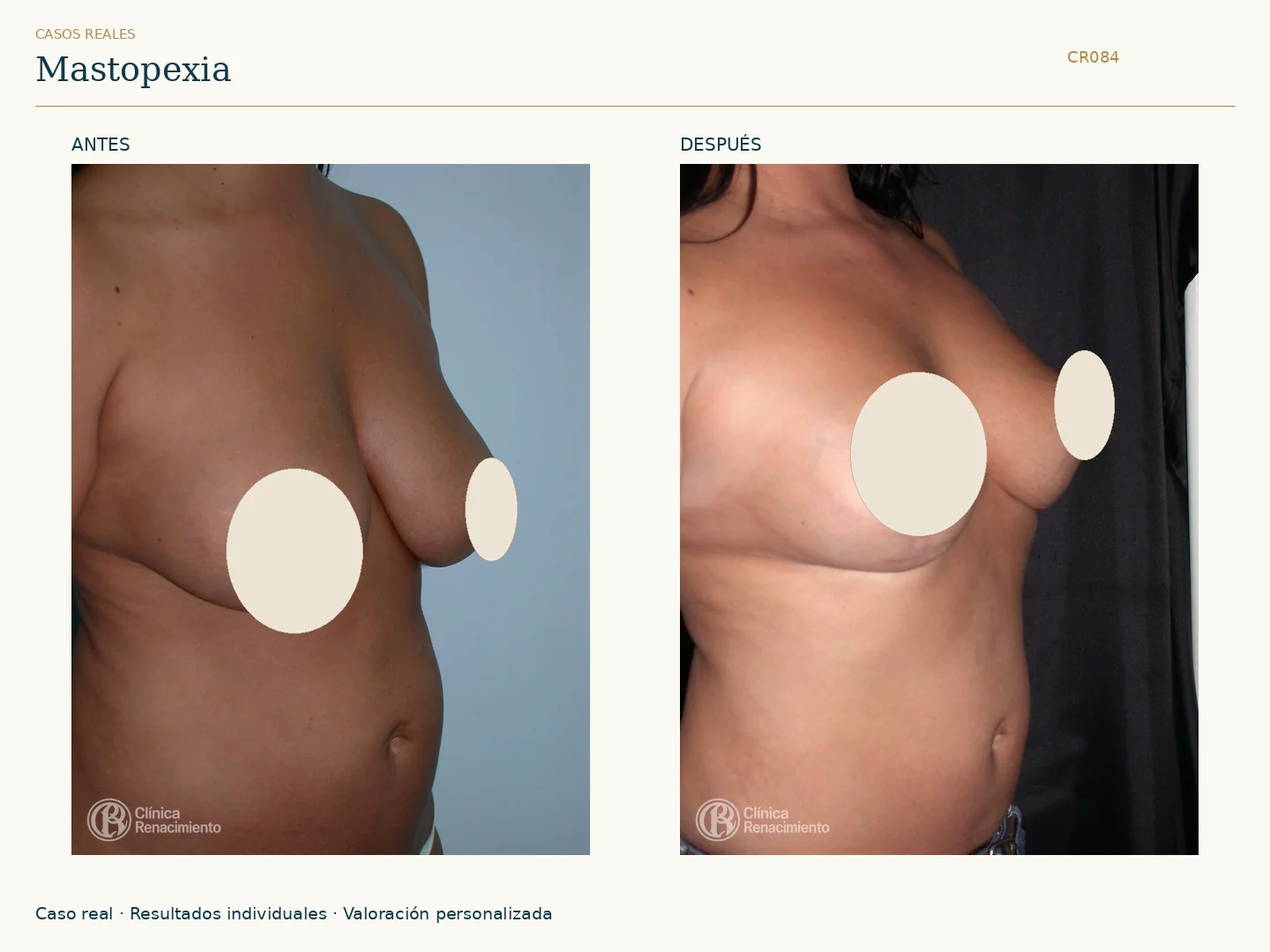 Elevación de senos / Mastopexia: antes y después, vista oblicua derecha. Clínica Renacimiento Marbella.