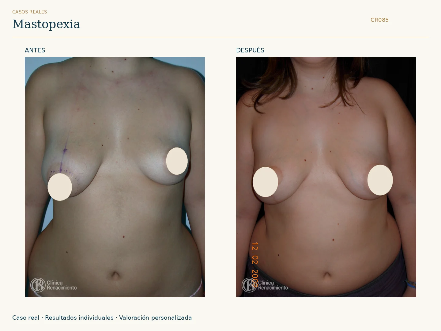 Elevación de senos / Mastopexia: antes y después, vista frontal. Clínica Renacimiento Marbella.