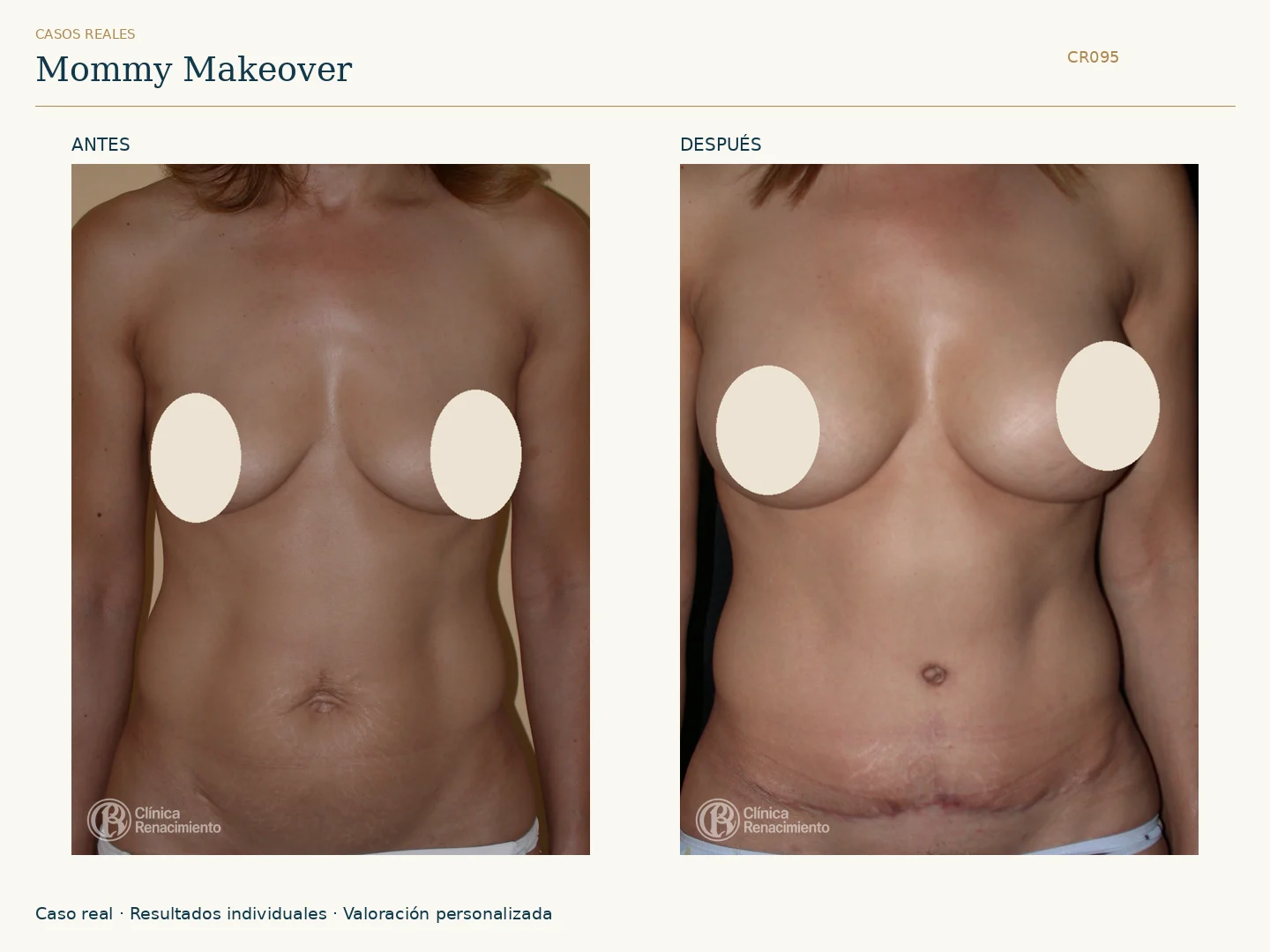 Mommy Makeover: antes y después, vista frontal. Clínica Renacimiento Marbella.