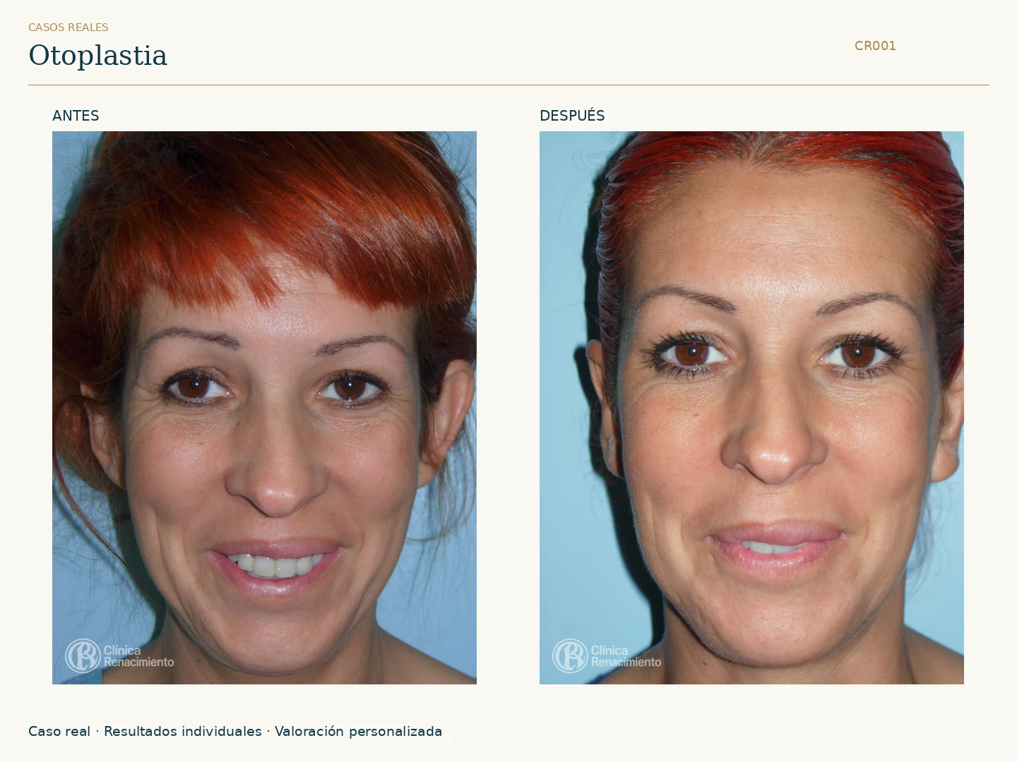 Orejas / Otoplastia: antes y después, vista frontal. Clínica Renacimiento Marbella.