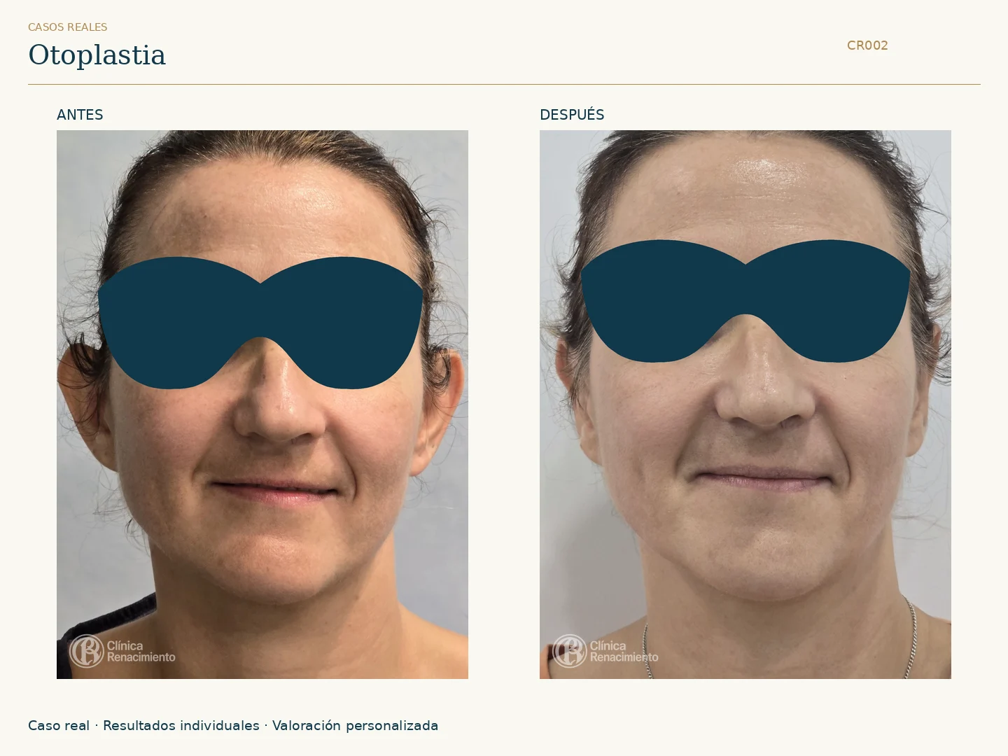 Orejas / Otoplastia: antes y después, vista frontal. Clínica Renacimiento Marbella.