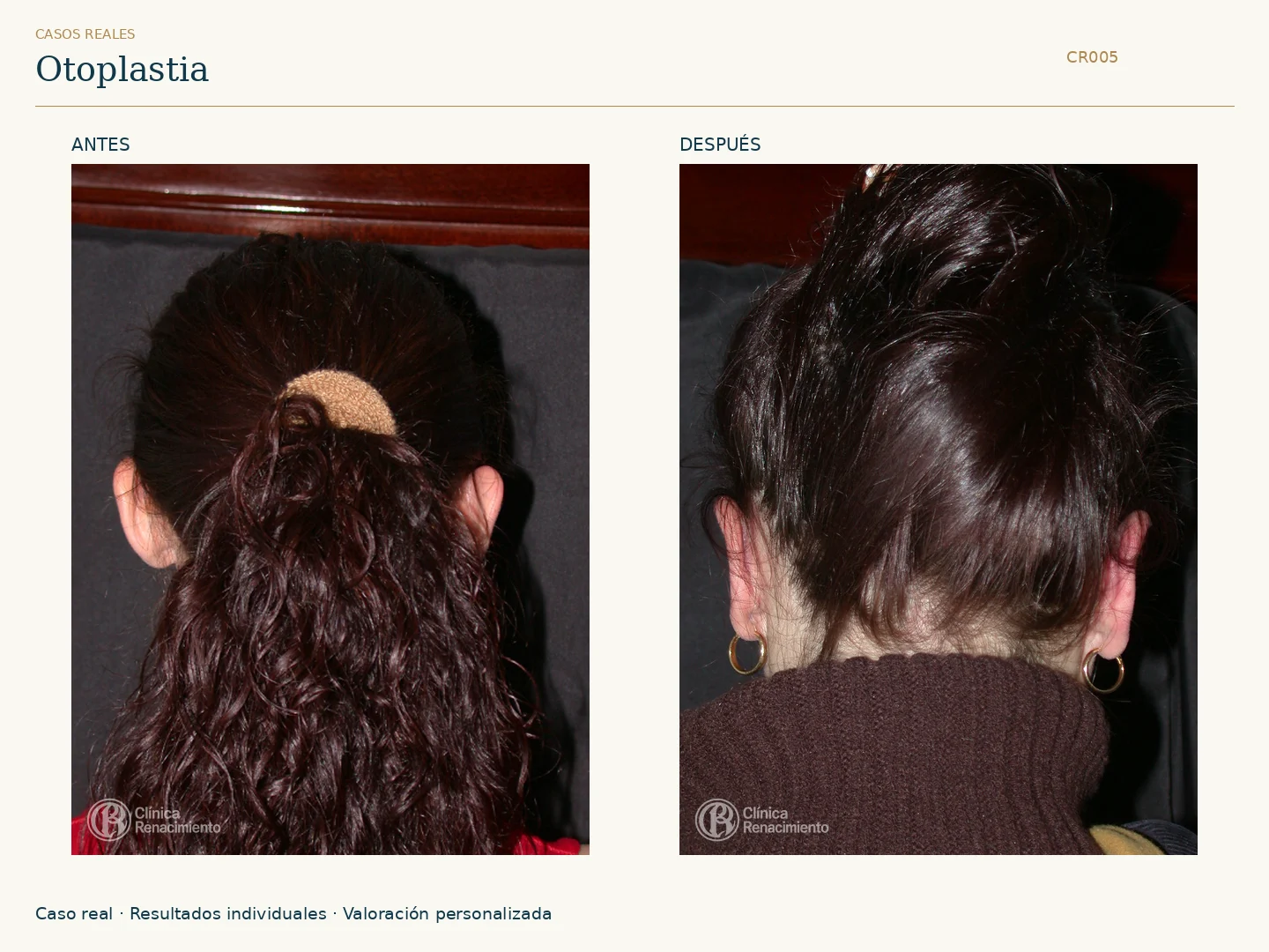Orejas / Otoplastia: antes y después, vista posterior 2003 2004. Clínica Renacimiento Marbella.