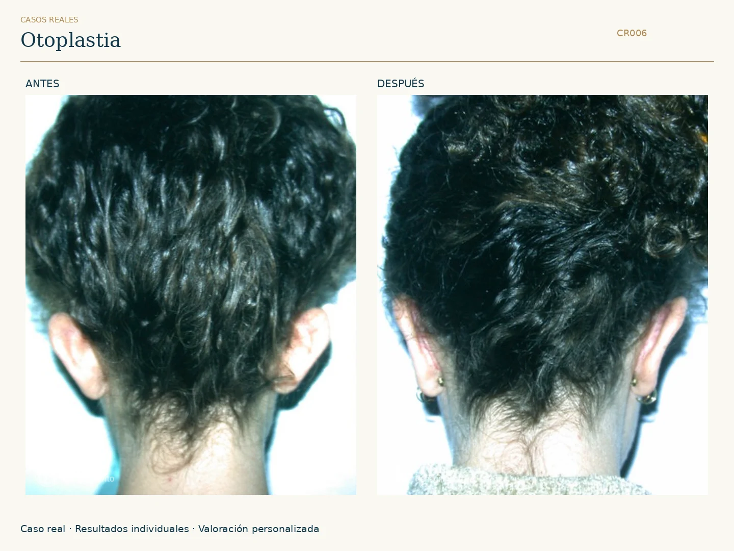 Orejas / Otoplastia: antes y después, vista posterior. Clínica Renacimiento Marbella.
