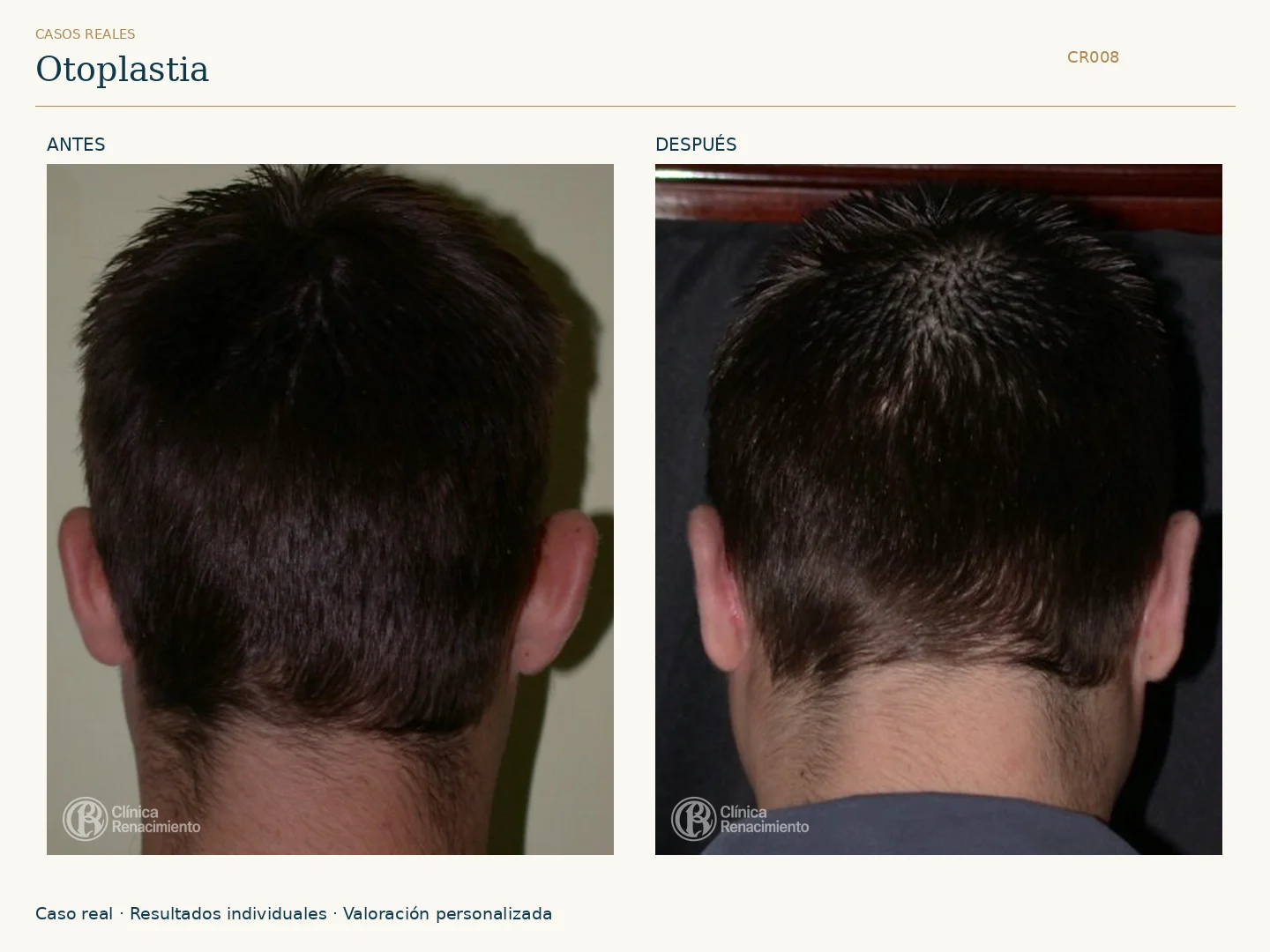 Orejas / Otoplastia: antes y después, vista posterior. Clínica Renacimiento Marbella.