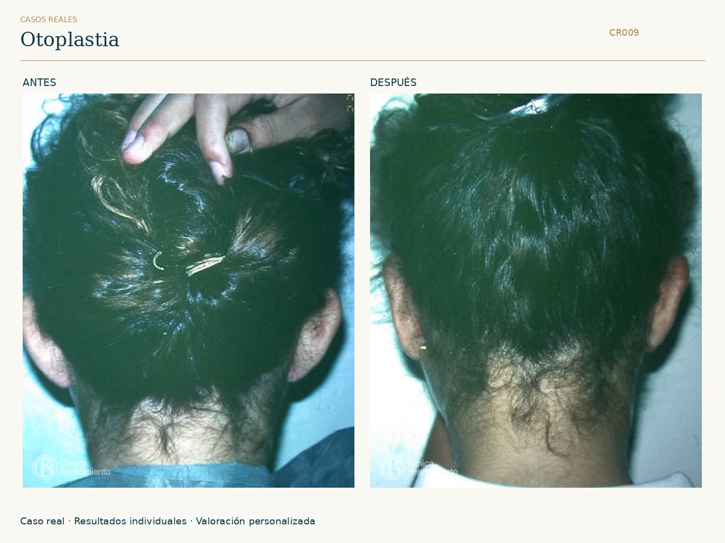Orejas / Otoplastia: antes y después, vista posterior. Clínica Renacimiento Marbella.
