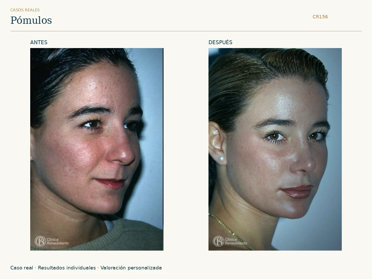 Pómulos / Malarplastia: antes y después, vista oblicua derecha. Clínica Renacimiento Marbella.