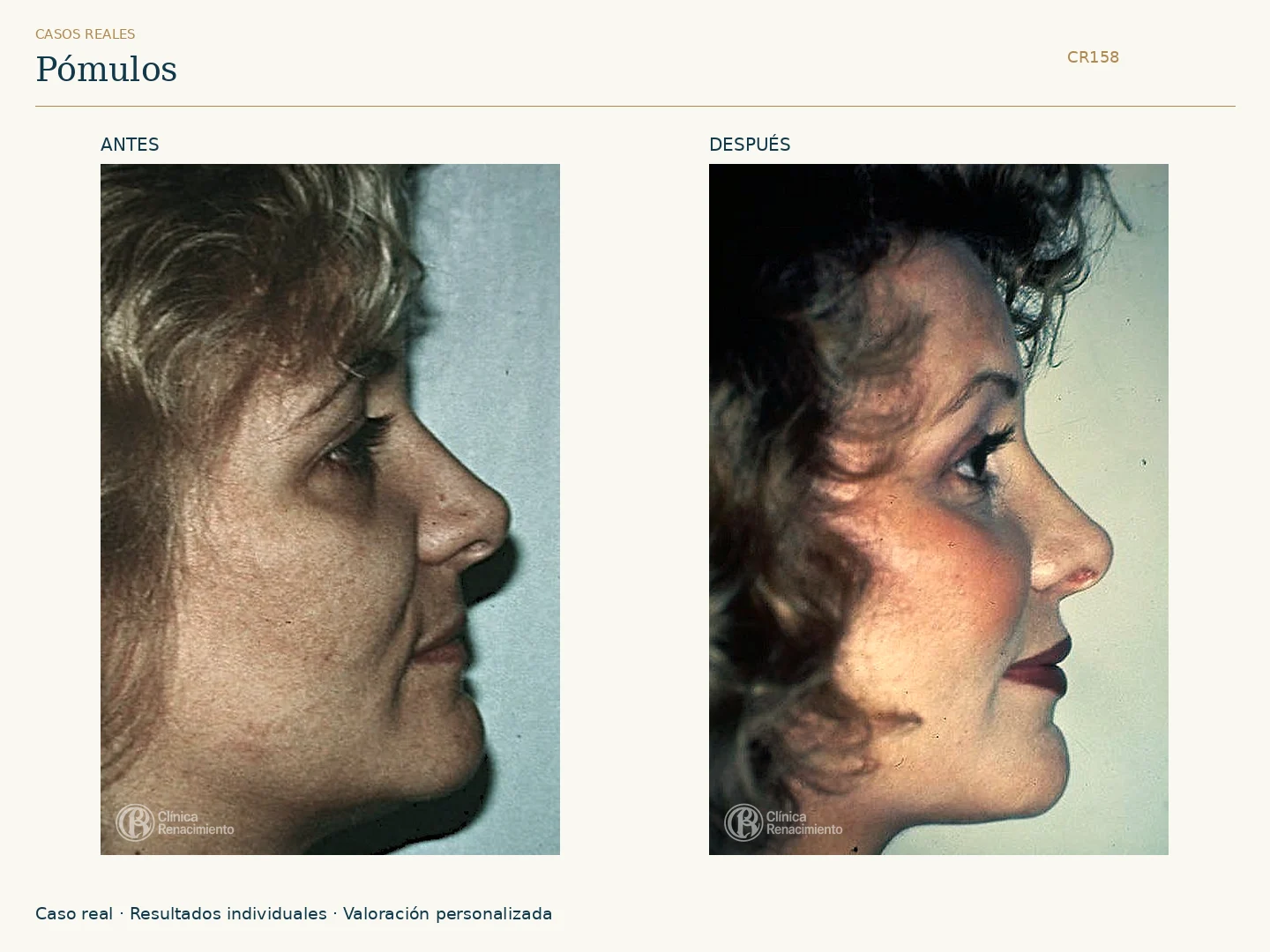 Pómulos / Malarplastia: antes y después, vista perfil derecho. Clínica Renacimiento Marbella.