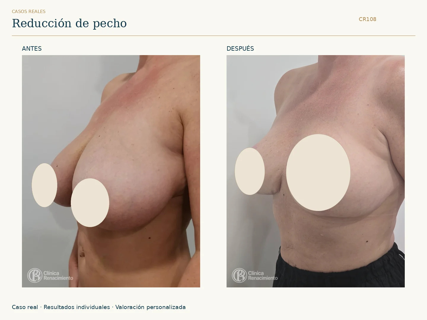 Reducción de senos / Mamoplastia de reducción: antes y después, vista oblicua. Clínica Renacimiento Marbella.