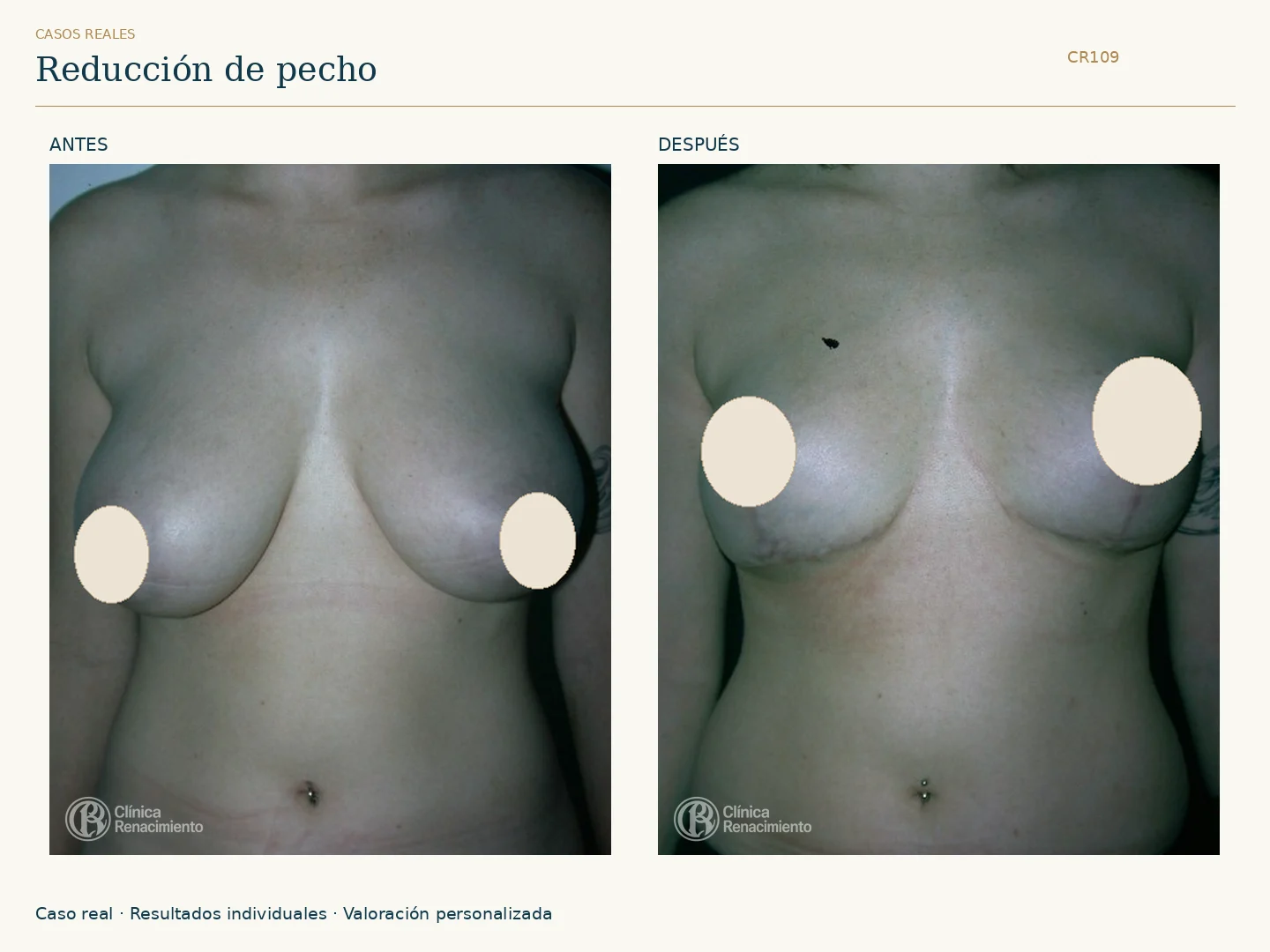 Reducción de senos / Mamoplastia de reducción: antes y después, vista frontal. Clínica Renacimiento Marbella.