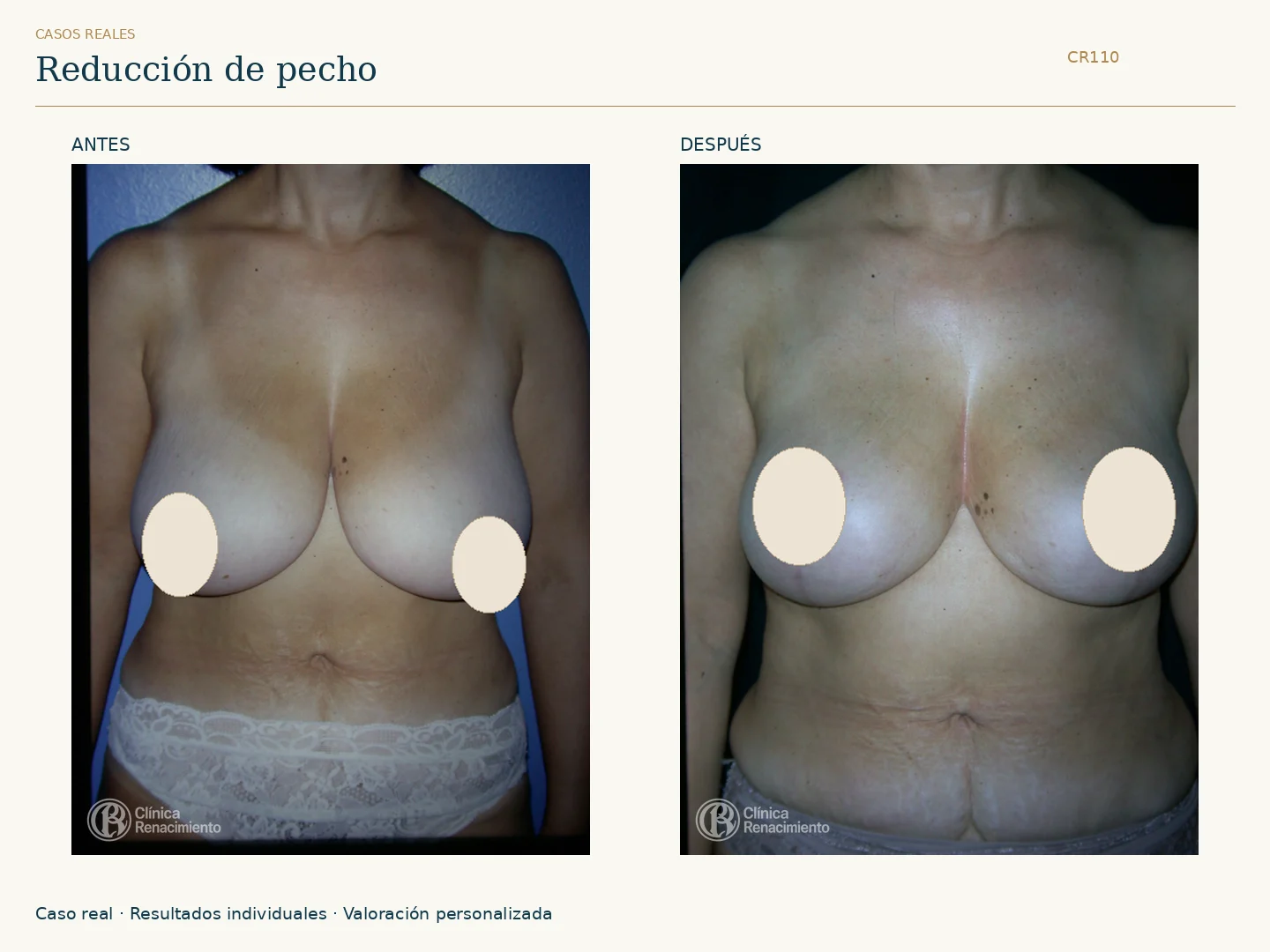 Reducción de senos / Mamoplastia de reducción: antes y después, vista frontal. Clínica Renacimiento Marbella.