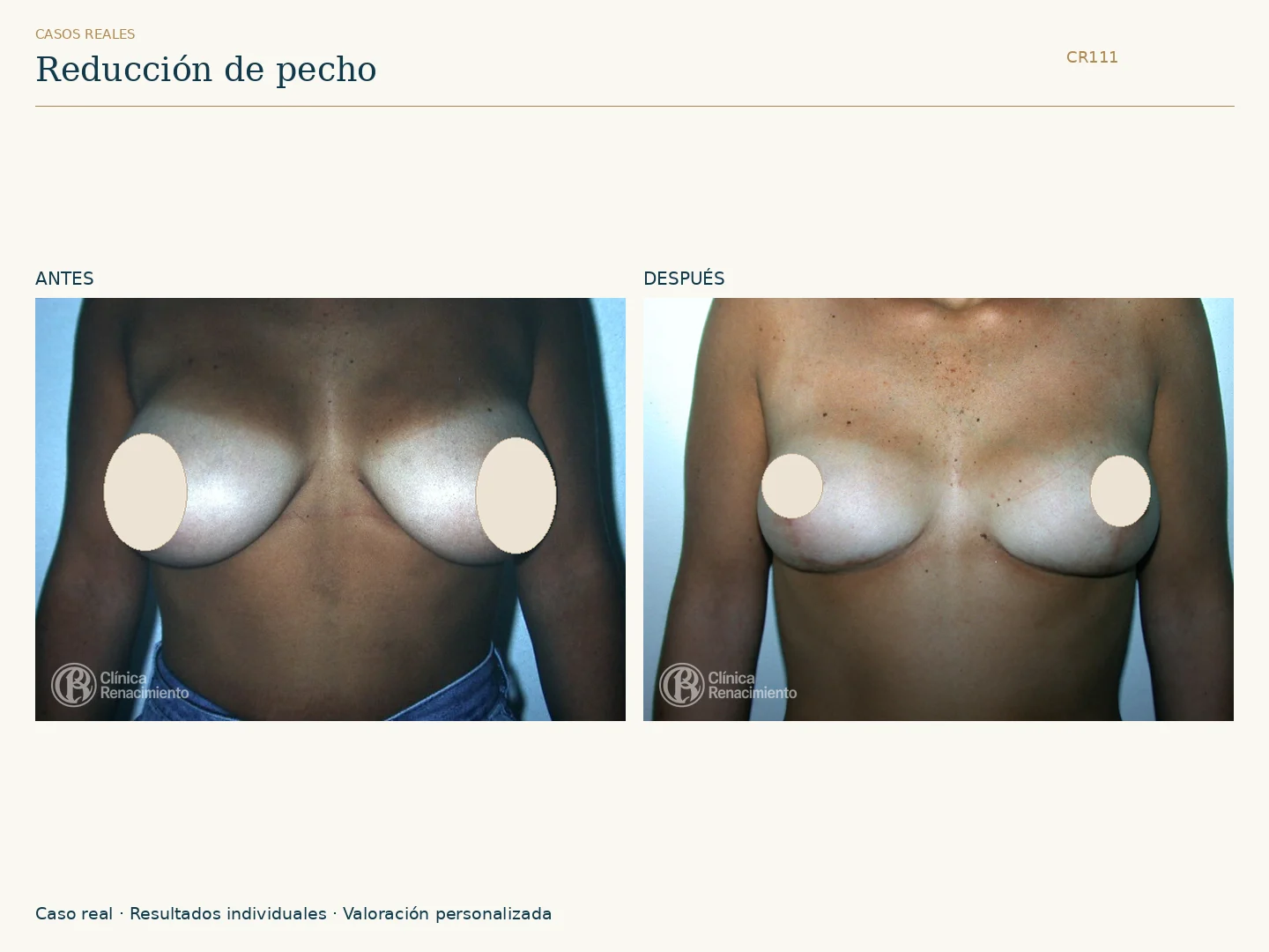 Reducción de senos / Mamoplastia de reducción: antes y después, vista frontal. Clínica Renacimiento Marbella.