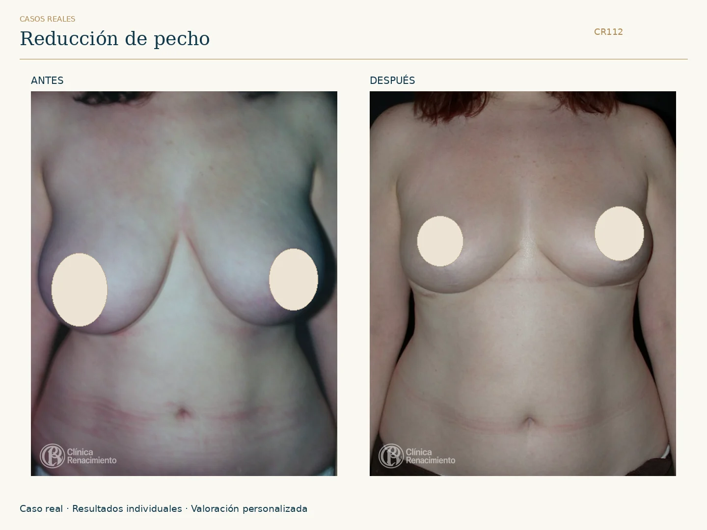 Reducción de senos / Mamoplastia de reducción: antes y después, vista frontal. Clínica Renacimiento Marbella.