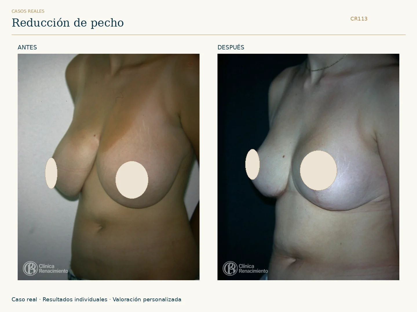 Reducción de senos / Mamoplastia de reducción: antes y después, vista oblicua. Clínica Renacimiento Marbella.