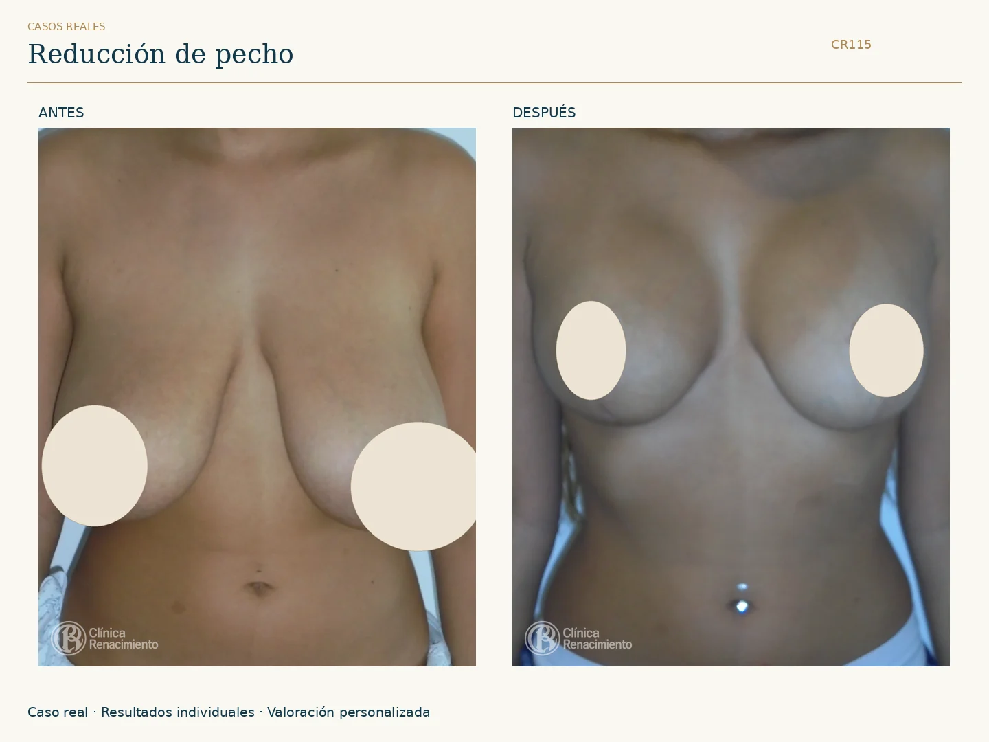 Reducción de senos / Mamoplastia de reducción: antes y después, vista frontal. Clínica Renacimiento Marbella.