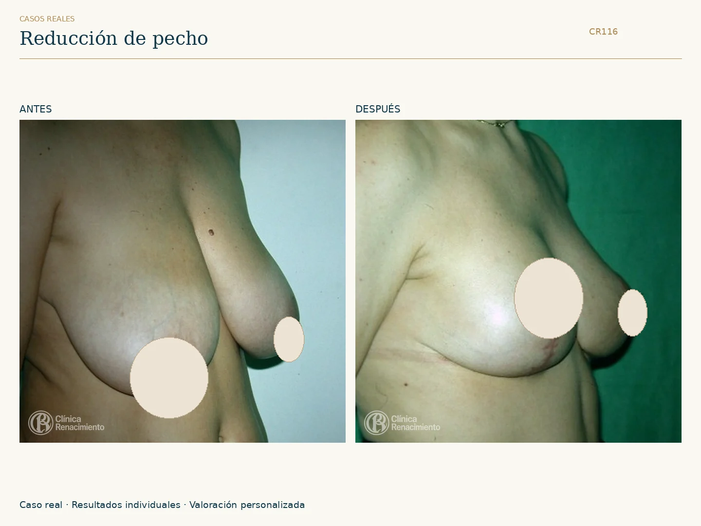 Reducción de senos / Mamoplastia de reducción: antes y después, vista oblicua. Clínica Renacimiento Marbella.