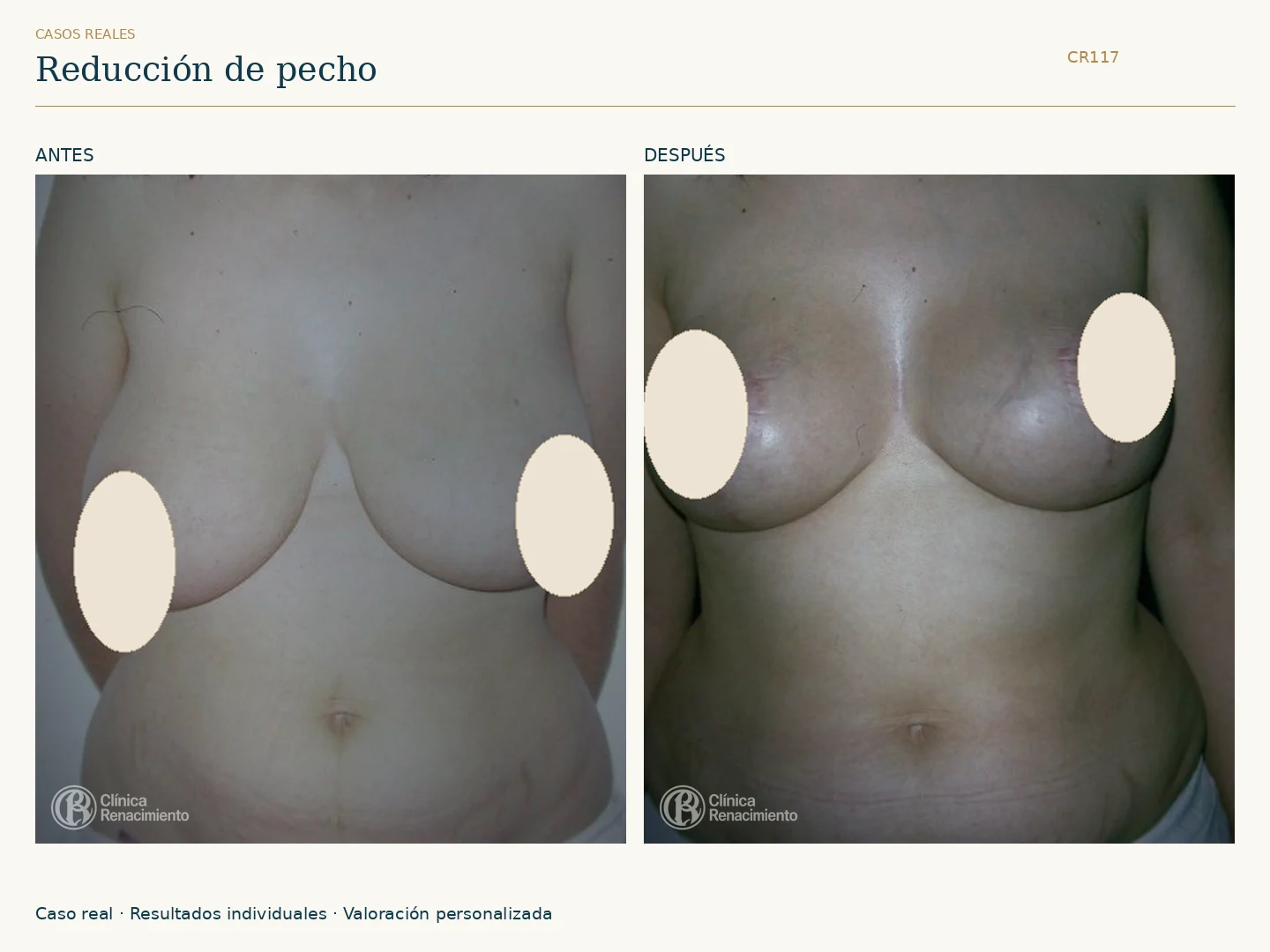 Reducción de senos / Mamoplastia de reducción: antes y después, vista frontal. Clínica Renacimiento Marbella.