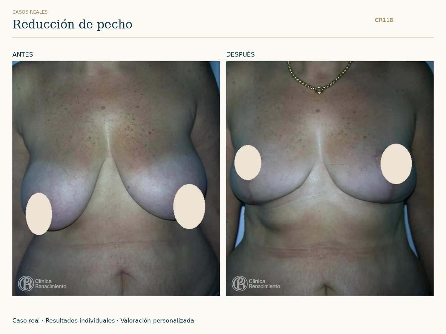 Reducción de senos / Mamoplastia de reducción: antes y después, vista frontal. Clínica Renacimiento Marbella.