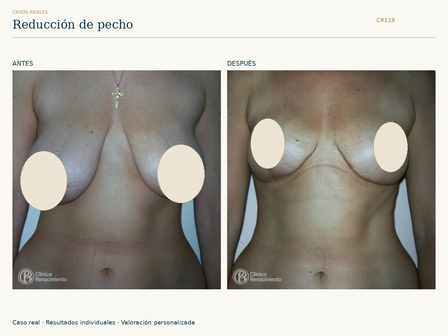 Reducción de senos / Mamoplastia de reducción: antes y después, vista frontal. Clínica Renacimiento Marbella.