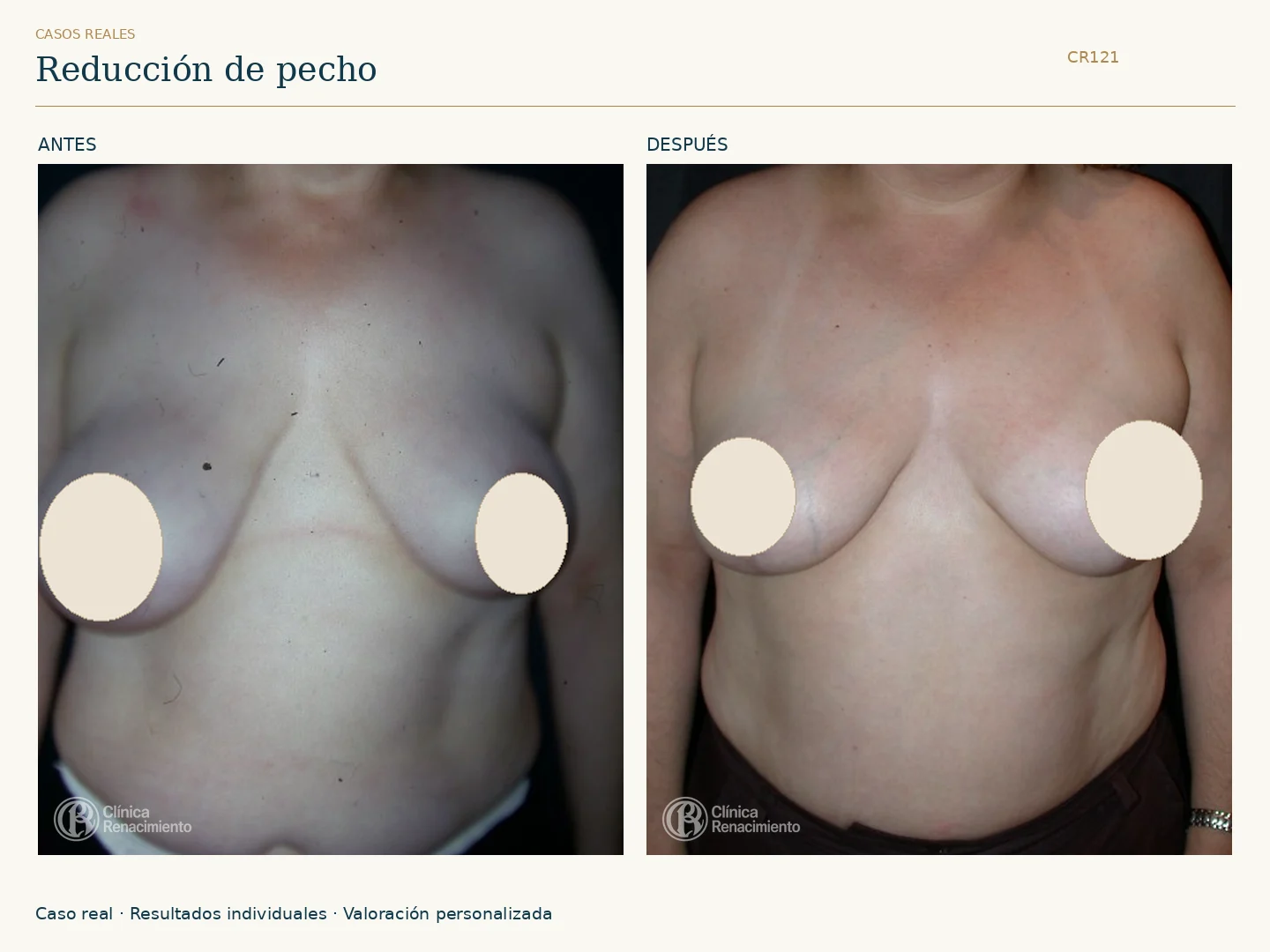 Reducción de senos / Mamoplastia de reducción: antes y después, vista frontal. Clínica Renacimiento Marbella.