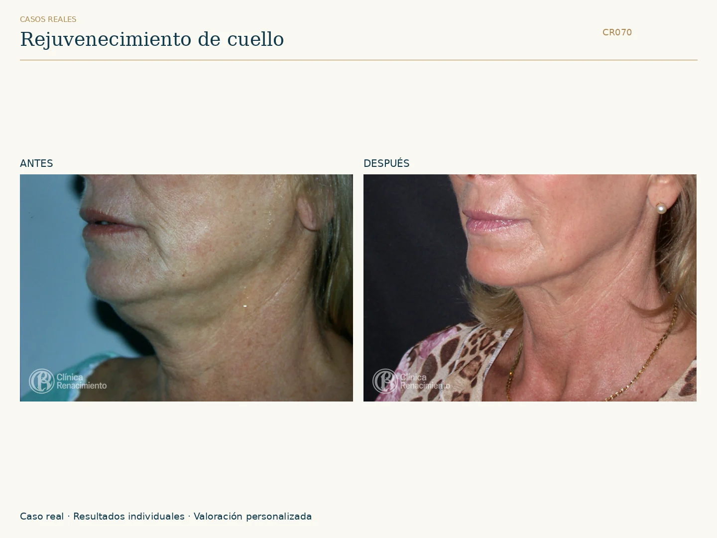 Rejuvenecimiento de Cuello: antes y después, vista oblicua izquierda. Clínica Renacimiento Marbella.