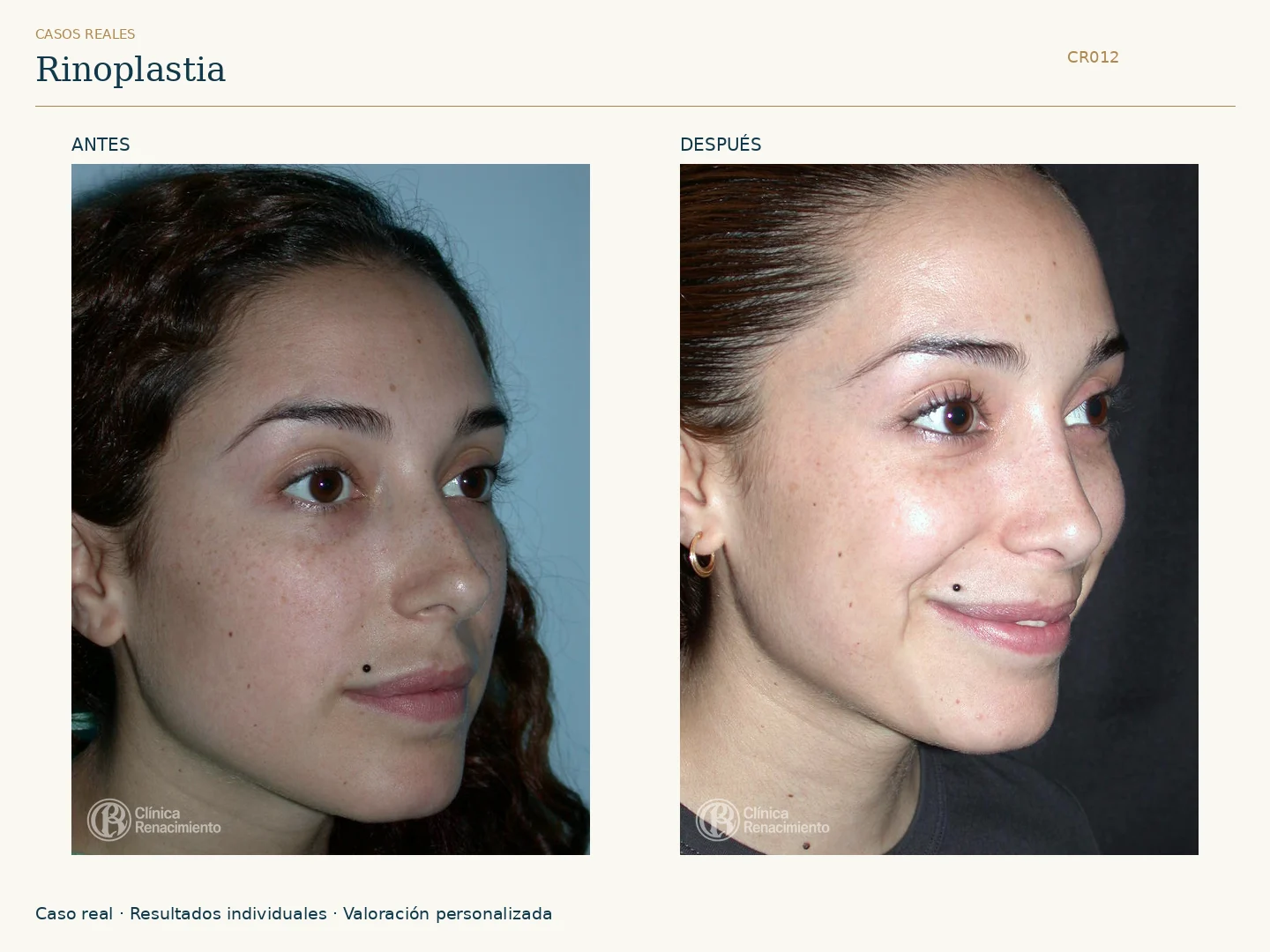 Nariz / Rinoplastia: antes y después, vista oblicua izquierda. Clínica Renacimiento Marbella.