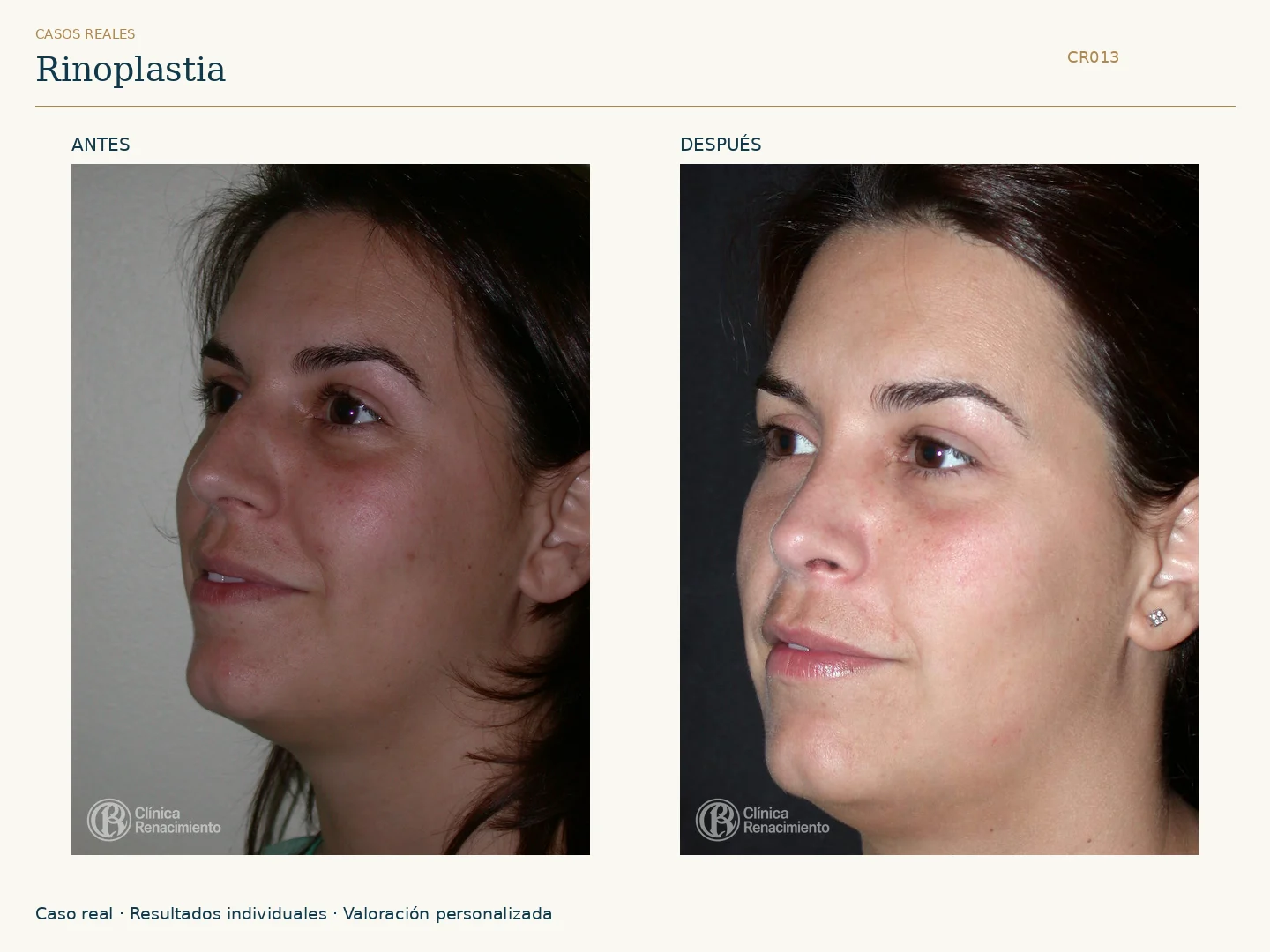 Nariz / Rinoplastia: antes y después, vista oblicua derecha. Clínica Renacimiento Marbella.