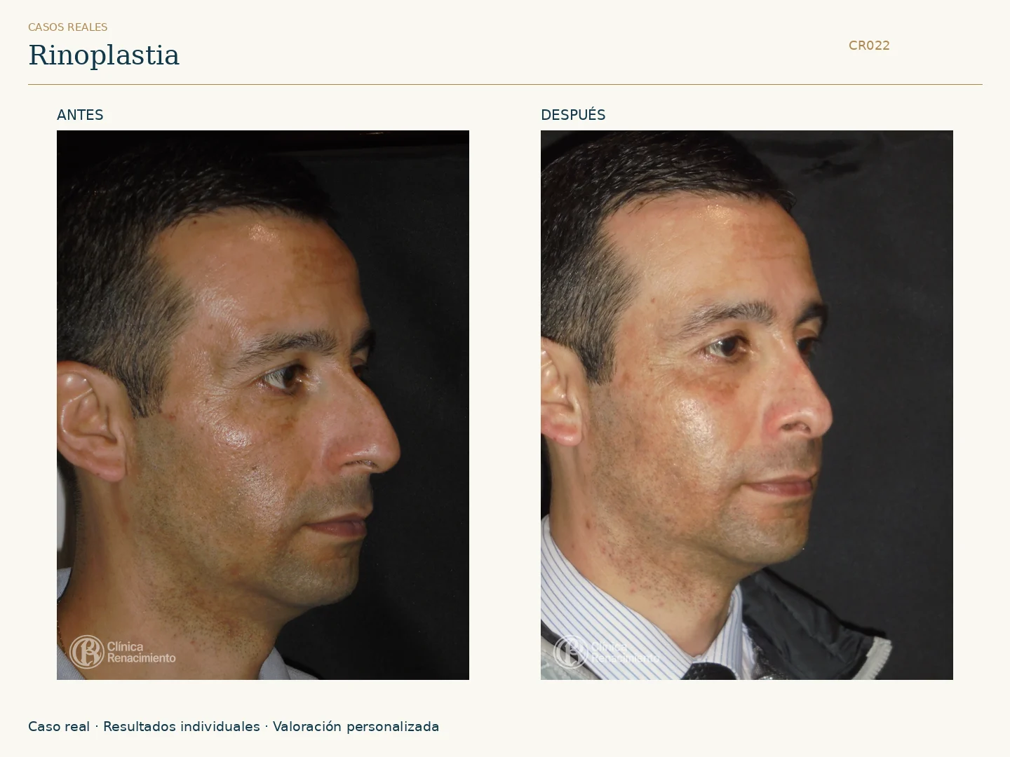 Nariz / Rinoplastia: antes y después, vista oblicua izquierda. Clínica Renacimiento Marbella.
