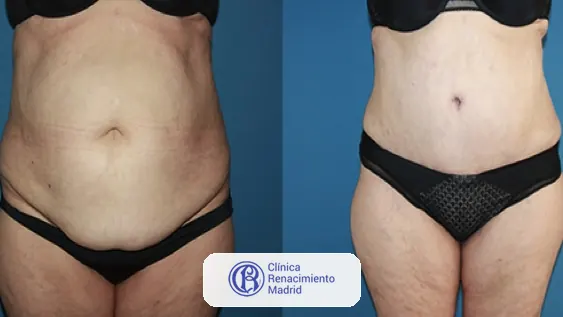 Caso real de abdominoplastia en Marbella antes y después paciente 1 | Clínica Renacimiento Marbella