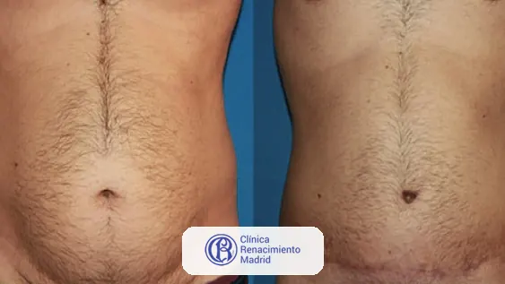 Caso real de abdominoplastia en Marbella antes y después paciente 6 | Clínica Renacimiento Marbella