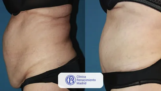 Caso real de abdominoplastia en Marbella antes y después paciente 2 | Clínica Renacimiento Marbella