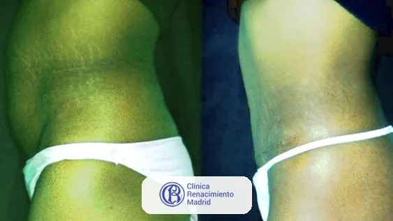 Caso real de abdominoplastia en Marbella antes y después paciente 4 | Clínica Renacimiento Marbella