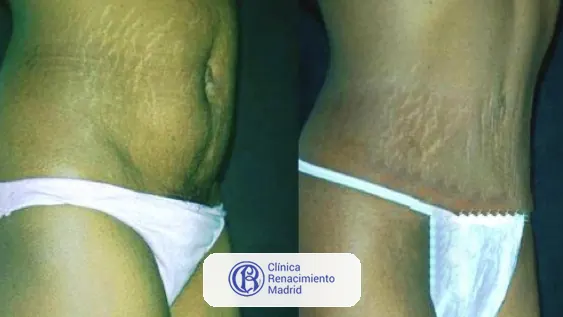 Caso real de abdominoplastia en Marbella antes y después paciente 5 | Clínica Renacimiento Marbella