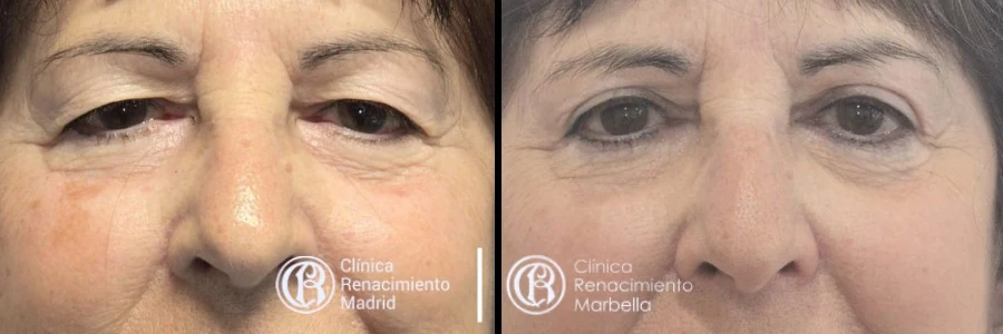 Antes y después de cirugía de párpados en Marbella, blefaroplastia paciente 2 | Clínica Renacimiento Marbella