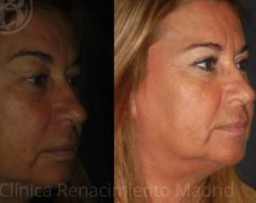 Caso real de blefaroplastia estética en Marbella antes y después paciente 7 | Clínica Renacimiento Marbella