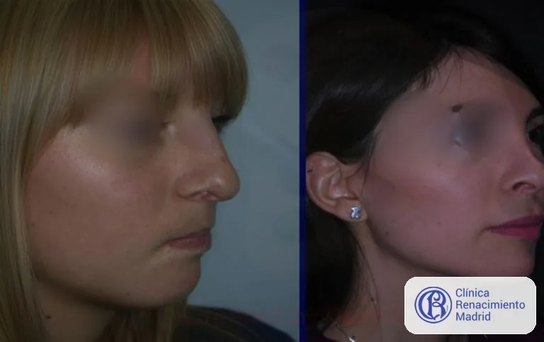 Caso real de Bichectomía / Bolas de Bichat en Marbella vista de perfil antes y después | Clínica Renacimiento Marbella