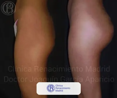 Caso real de prótesis de glúteos en Marbella antes y después paciente 5 | Clínica Renacimiento Marbella