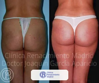 Caso real de prótesis de glúteos en Marbella antes y después paciente 9 | Clínica Renacimiento Marbella