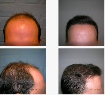image of Real case hair transplant clinic renaissance Marbella 2