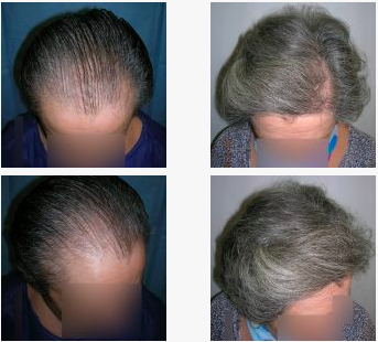 image of Real case hair transplant clinic renaissance Marbella 1