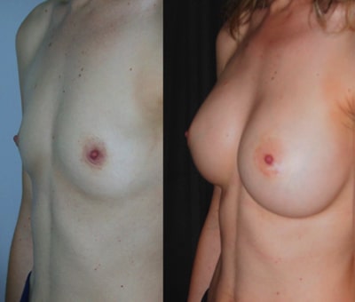 image of breast augmentation rebirth madrid