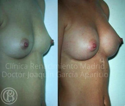 vor und nach dem Fallbild echte Brustvergrößerungsklinik Renaissance Madrid 2
