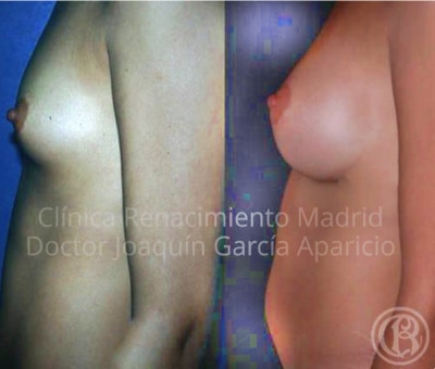 قبل وبعد حالة الصورة عيادة تكبير الثدي الحقيقية النهضة مدريد 3