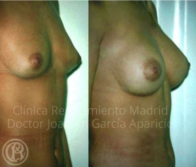 قبل وبعد حالة الصورة عيادة تكبير الثدي الحقيقية النهضة مدريد 5