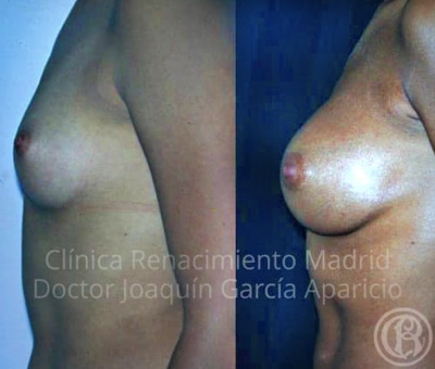 before and after case image real breast augmentation clinic renaissance madrid