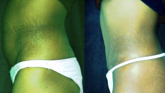 imagen de caso real antes y despues abdominoplastia clinica renacimiento madrid 5