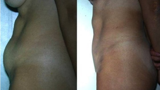 imagen de caso real antes y despues abdominoplastia clinica renacimiento madrid 8