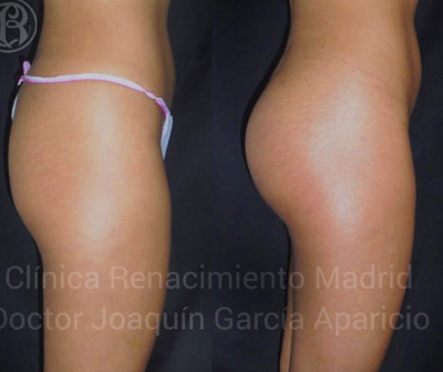 Bild des realen Falles vor und nach Gesäßprothesenklinik Renaissance Madrid 1