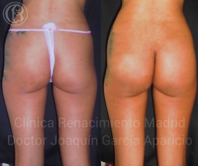 Bild des realen Falles vor und nach Gesäßprothesenklinik Renaissance Madrid 3